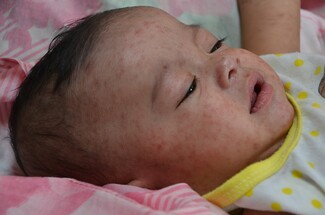 A child with measles. Photograph by CDC Global, Jim Goodson, Public Domain, https://commons.wikimedia.org/w/index.php?curid=76594880