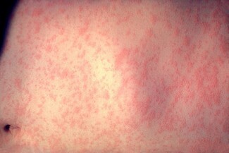 Measles in an adult. Photograph by CDC/Dr. Heinz F. Eichenwald - This media comes from the Centers for Disease Control and Prevention's Public Health Image Library. Wikimedia